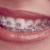 Metal braces dental treatment in Dubai UAE